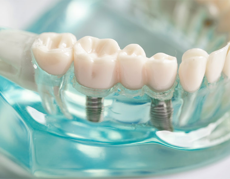 Implantes Dentários Baratos
