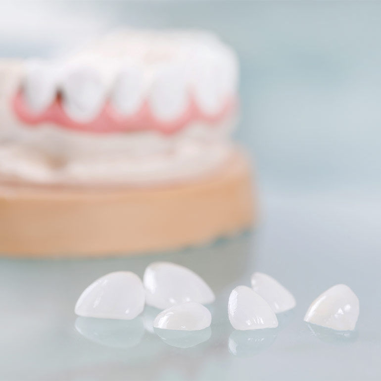 Preços das Facetas Dentárias