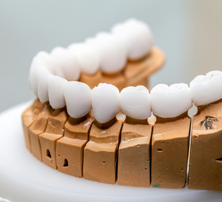Próteses Dentárias Fixas