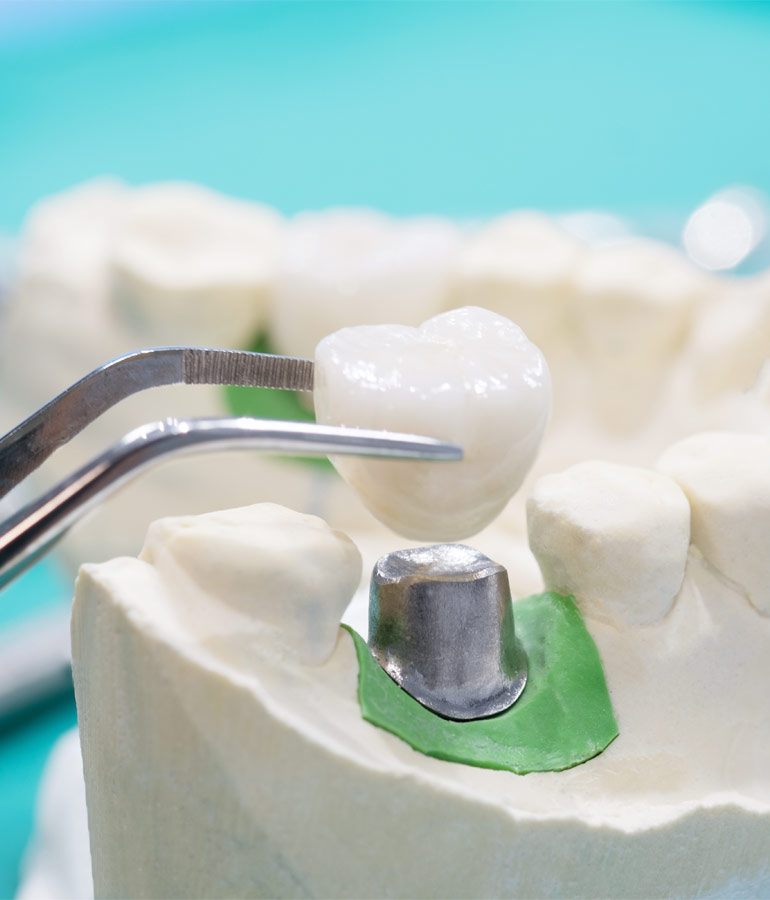 Tipos de Coroas Dentárias