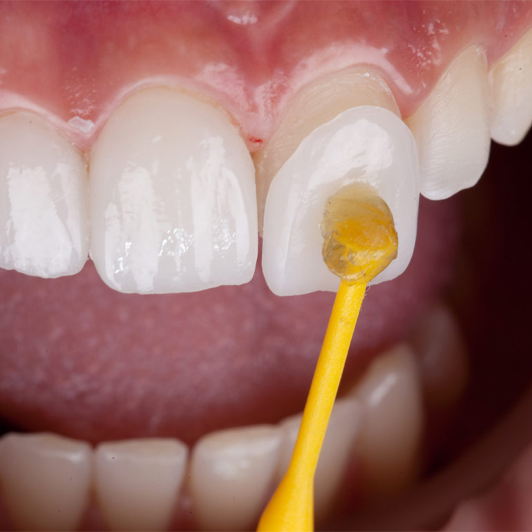Tipos de Facetas Dentárias