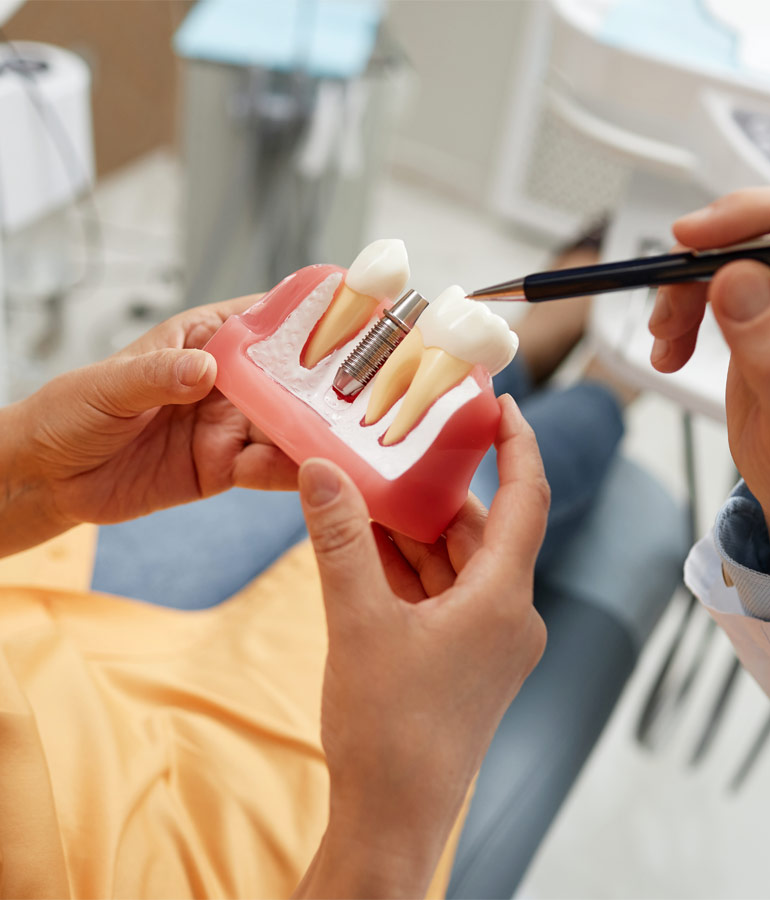 Tipos de Implantes Dentários