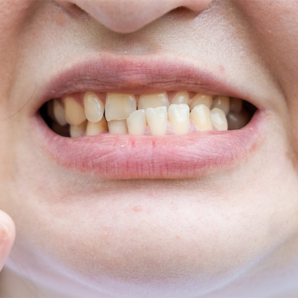 Tratamento da Disfunção da Articulação Temporomandibular (ATM)