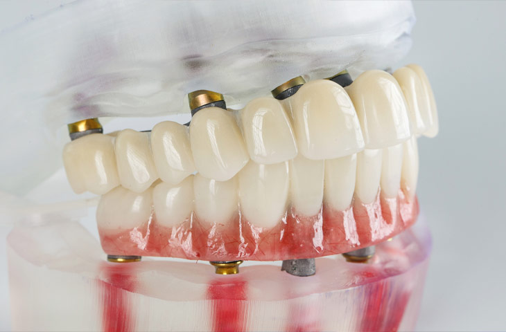 Implantes Dentários